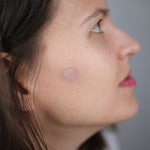 Micro-needle acne patch